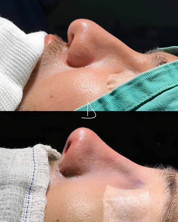 Rinoplastia, antes e depois · Dr. Ricardo Almeida