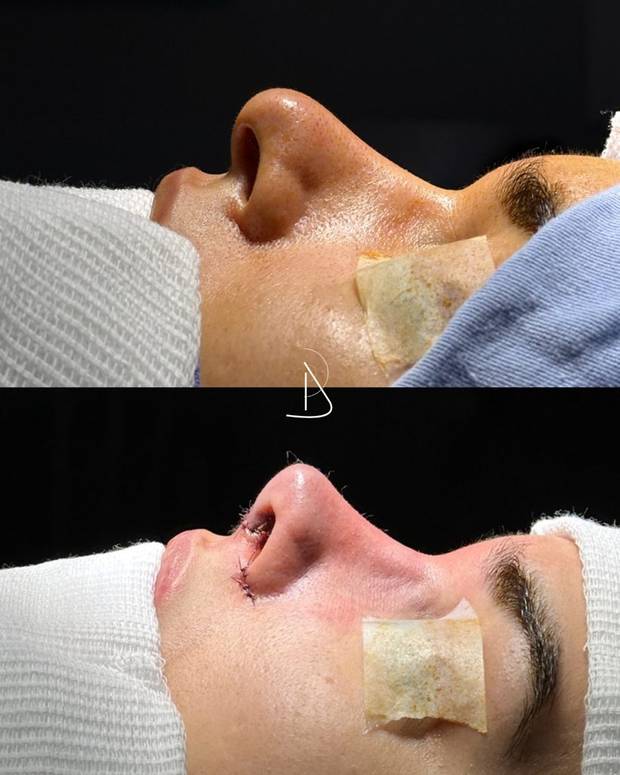 Rinoplastia, antes e depois · Dr. Ricardo Almeida