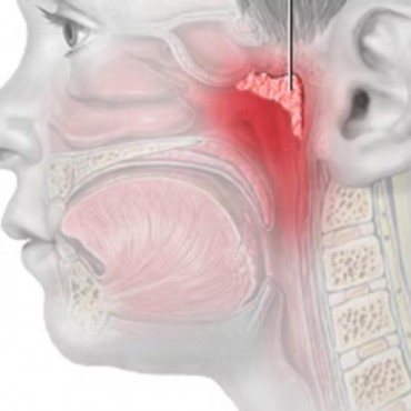 Adenoidectomia em Anápolis