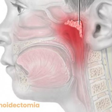 Adenoidectomia em Águas Lindas de Goiás