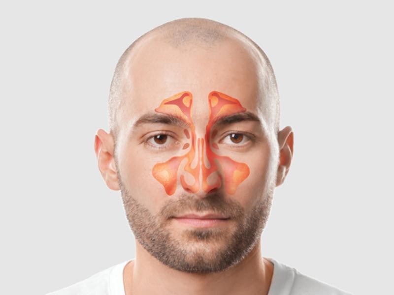 Sinusectomia