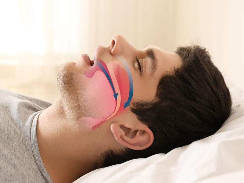 Cirurgia para Correção de Apneia do Sono